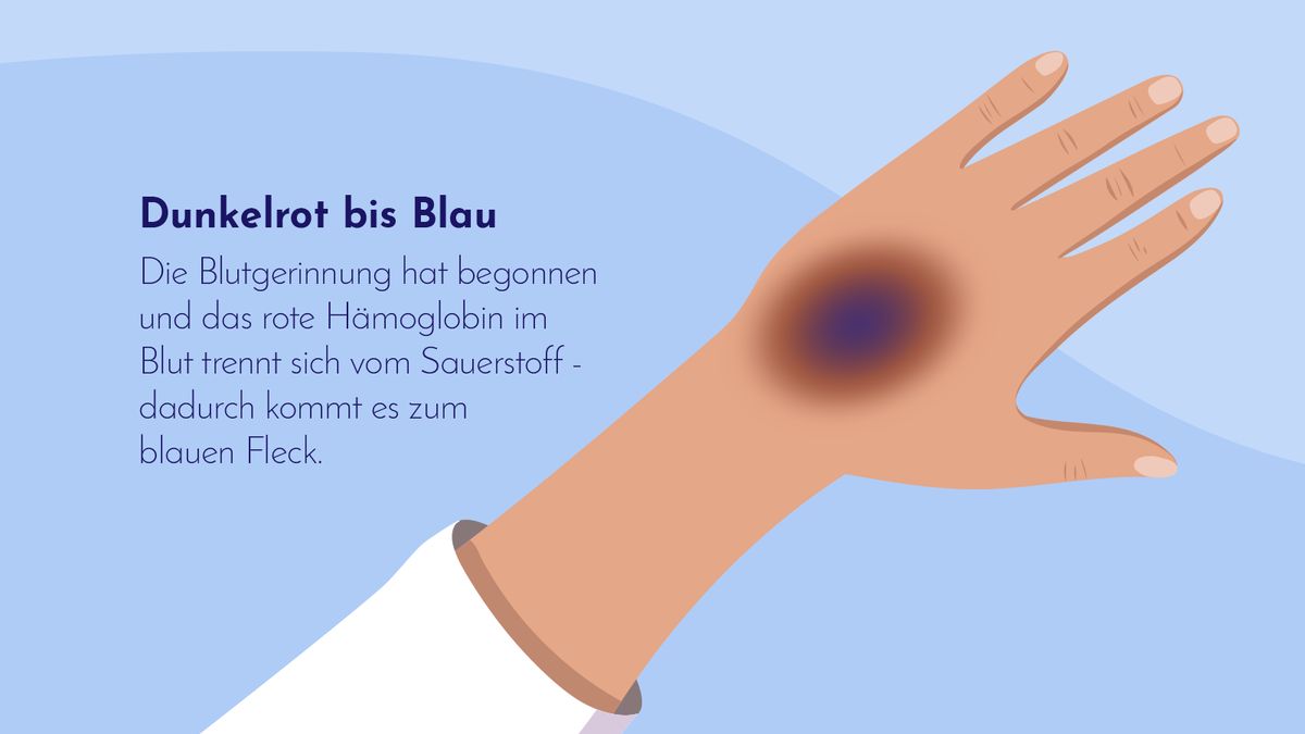 Dunkelrot bis Blau: Die Blutgerinnung hat begonnen. Dunkelrot bis Blau: Die Blutgerinnung hat begonnen.