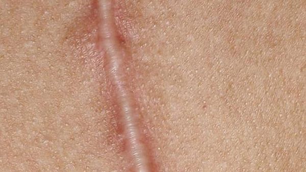 Ganz so stark ist die seltsame Linie am Penis des Mannes nicht ausgeprägt - doch die hier gezeigte Narbe sieht dem rätselhaften Strich schon sehr ähnlich. - Foto: iStock